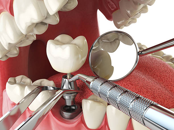 Best Emergency Dentist for Lost Fillings or Crowns in Rock Island, WA