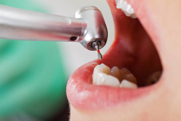 Best Emergency Dentist for Knocked-Out Tooth in Rock Island, WA